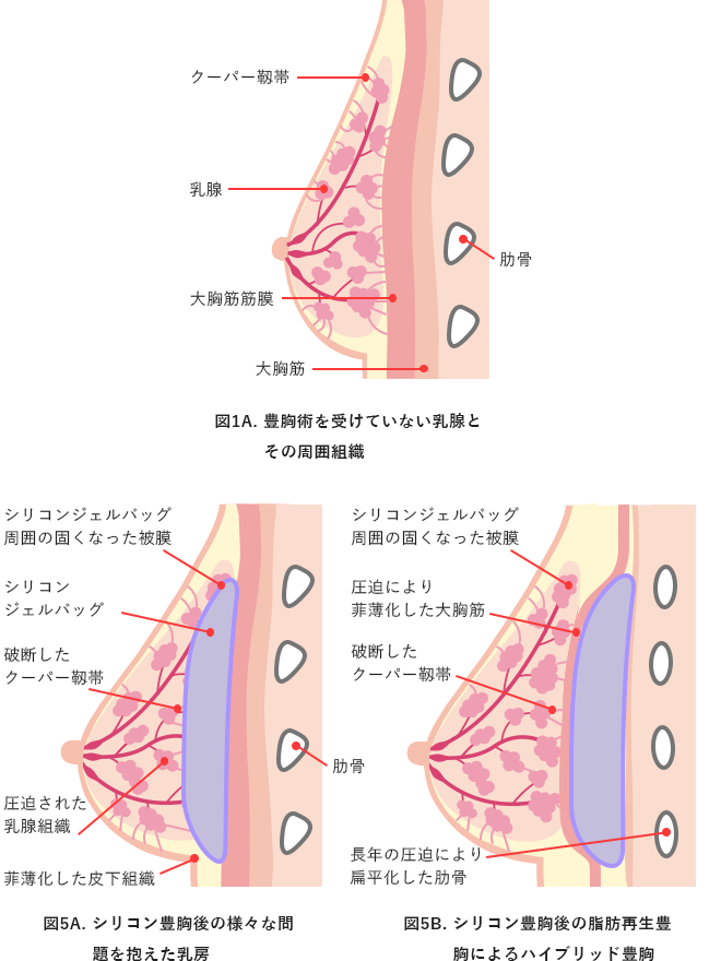 図3. 脂肪再生豊胸溶液 100(総量 200ml)注入で増加したバストの長さの経時的変化